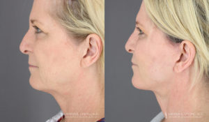 Neck Lift/Facelift Patient 3565 B&A C