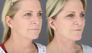 Neck Lift/Facelift Patient 3565 B&A D