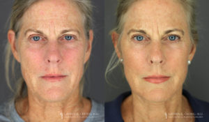 Neck Lift/Facelift Patient 7804 Before & After A