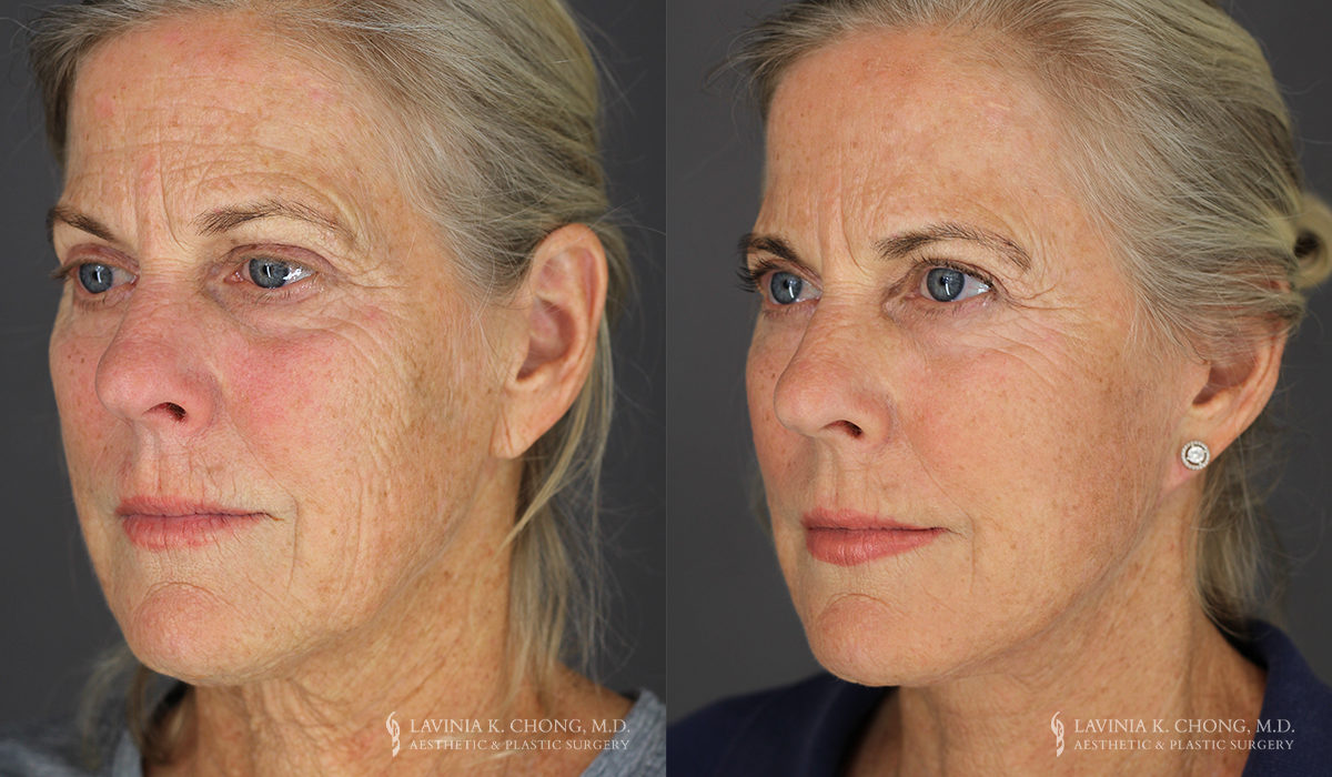 Neck Lift/Facelift Patient 7804 Before & After B
