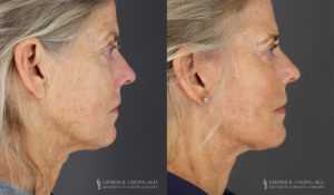 Neck Lift/Facelift Patient 7804 Before & After C