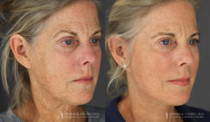 Neck Lift/Facelift Patient 7804 Before & After D