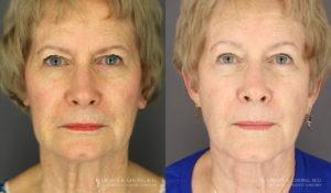 Neck Lift/Facelift Patient 8175 Before & After A