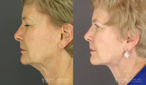 Neck Lift/Facelift Patient 8175 Before & After B