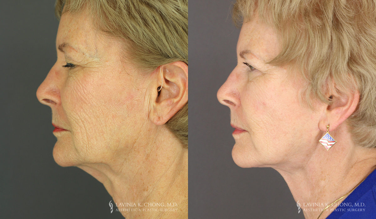 Neck Lift/Facelift Patient 8175 Before & After B