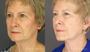 Neck Lift/Facelift Patient 8175 Before & After C