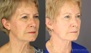 Neck Lift/Facelift Patient 8175 Before & After D