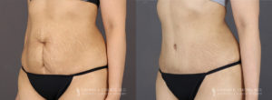 Tummy Tuck Patient 8346 Before & After A