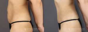 Tummy Tuck Patient 8346 Before & After B