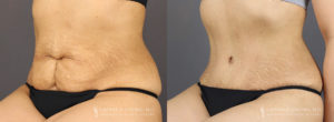 Tummy Tuck Patient 8346 Before & After C