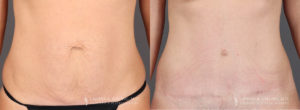 Tummy Tuck Patient 8355 Before & After A