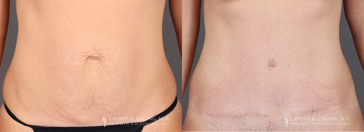 Before and After Tummy Tuck