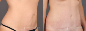 Tummy Tuck Patient 8355 Before & After B