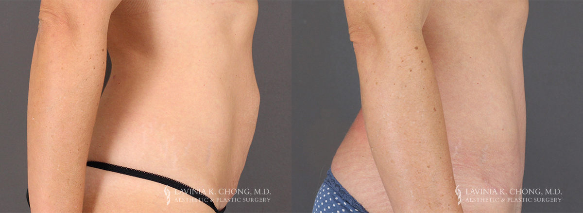 Tummy Tuck Patient 8355 Before & After C