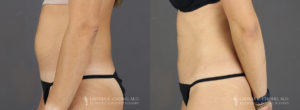 Tummy Tuck Patient 8747 Before & After A