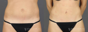 Tummy Tuck Patient 8747 Before & After B