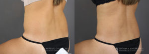 Tummy Tuck Patient 8747 Before & After C