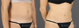 Tummy Tuck Patient 8747 Before & After D