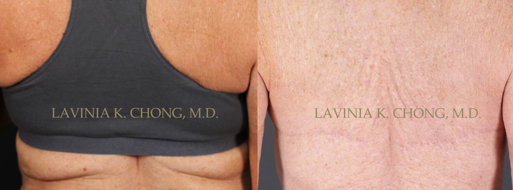 Real patient pre and post dorsal roll bra lift for the back | lavinia k chong m D