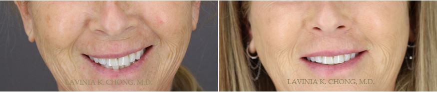 Real smiling patient results showing pre op photo and post op photo of upper lip lift with board certified female plastic surgeon in newport beach orange county | lavinia k chong m D