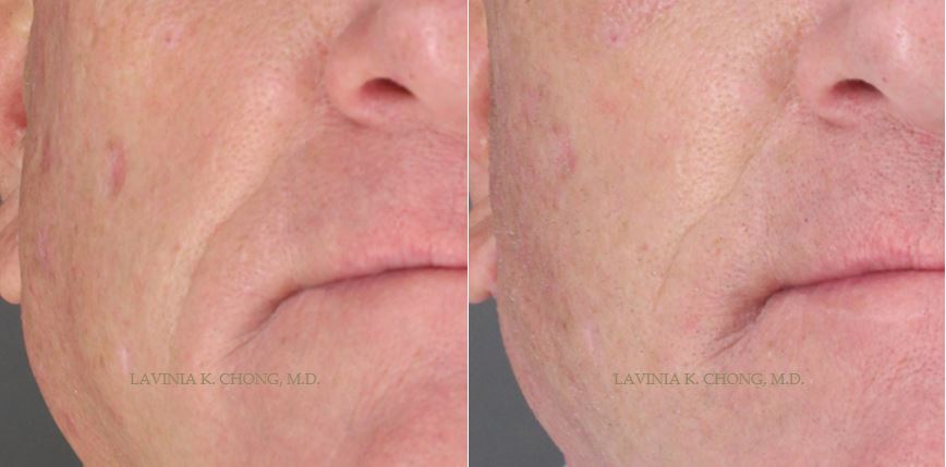 Before and After photos of male MACS (Short Scar) Facelift and Resection of Buccal Fat Pads with board-certified female plastic surgeon in Newport Beach, Orange County.