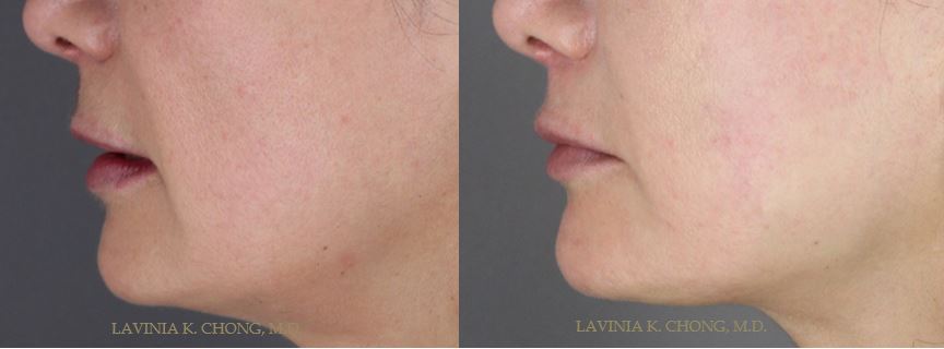 Before and After photos of female MACS (Short Scar) Facelift, Submental Liposuction, and Fat Grafting with Staged Upper Lip Lift performed by board-certified female plastic surgeon in Newport Beach, Orange County.