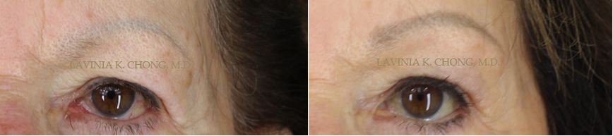 Before and After photos of Unilateral (left brow) Sliding Subcutaneous Brow Lift with board certified female plastic surgeon in Newport Beach, Orange County.