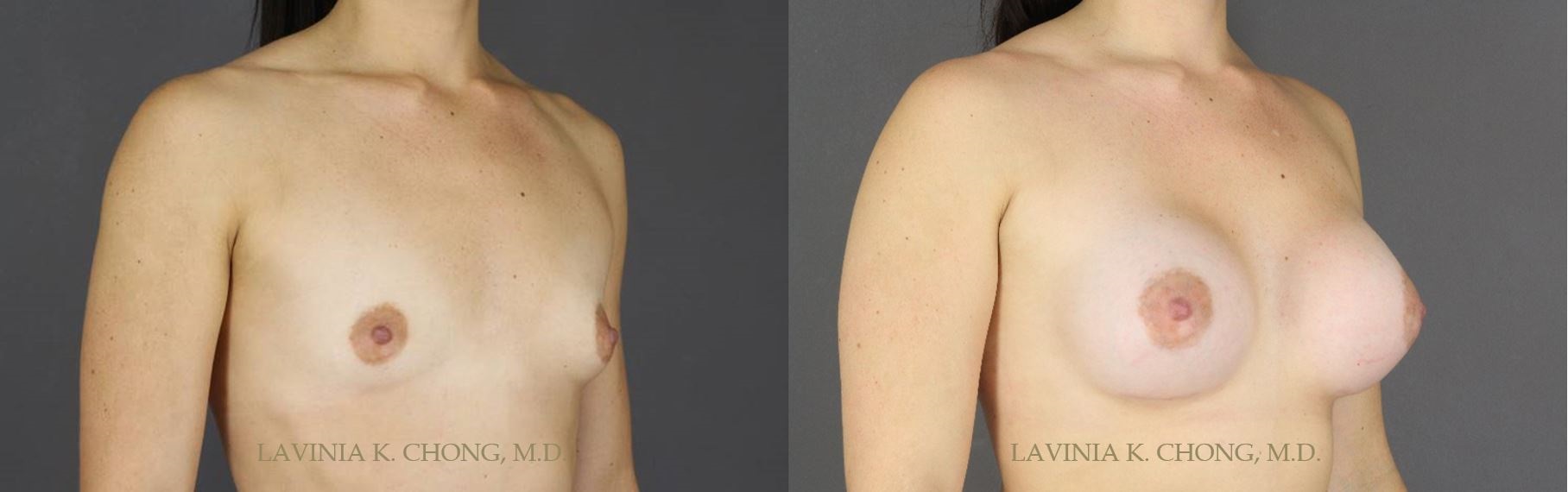 Before and After photo of 23 yr old with Hypomastia and Breast Asymmetry treated with Breast Augmentation and Mentor SHPB 400cc and 480cc High Profile Boost Silicone Implants with Application of DuraSorb by female plastic surgeon in Newport Beach, California.