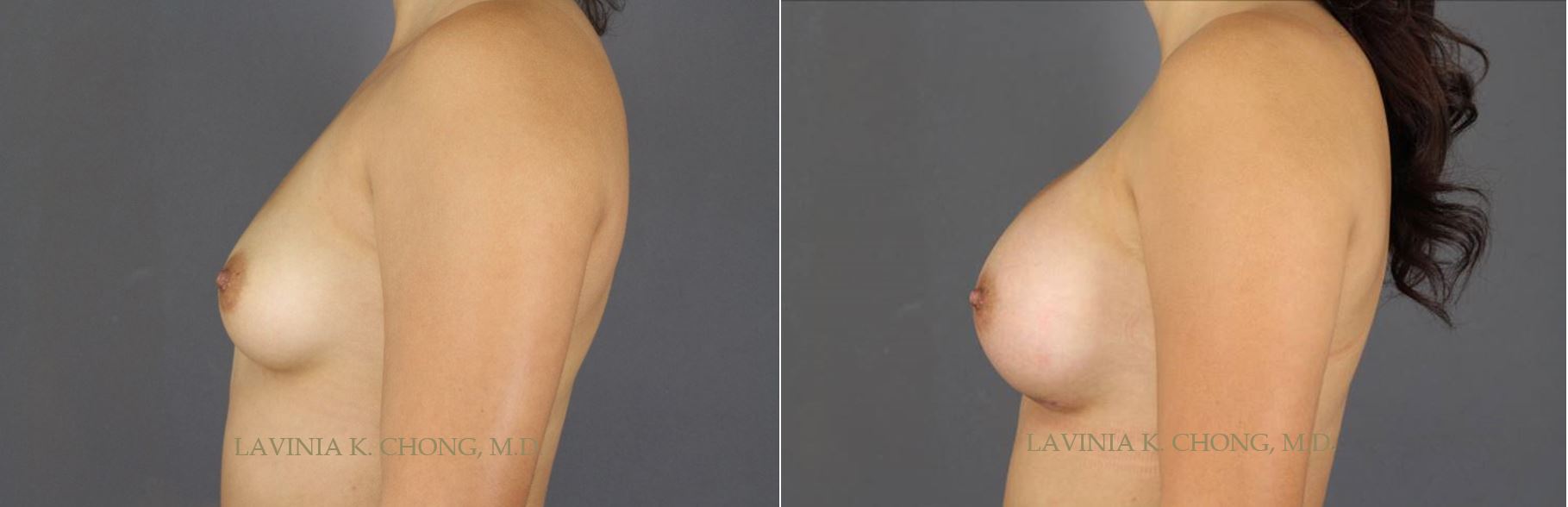 Before and After photo of 25 yr old with Hypomastia and Chest Wall Anterior Hypoplasia treated with Breast Augmentation and Mentor SHPX 380cc High Profile Silicone Implants with Application of DuraSorb by female plastic surgeon in Newport Beach, California.