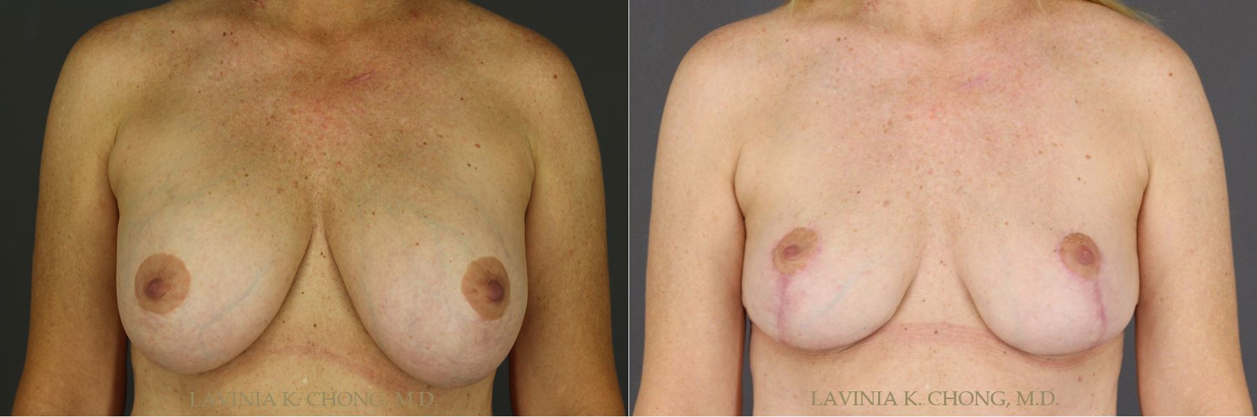 Before and After photo of 51 yr old with Breast Implant Malposition and Stretch Deformity. Surgical plan includes Implant Explantation with Mastopexy and Application of DuraSorb by female plastic surgeon in Newport Beach, California to achieve patient desire for smaller lifted breast.