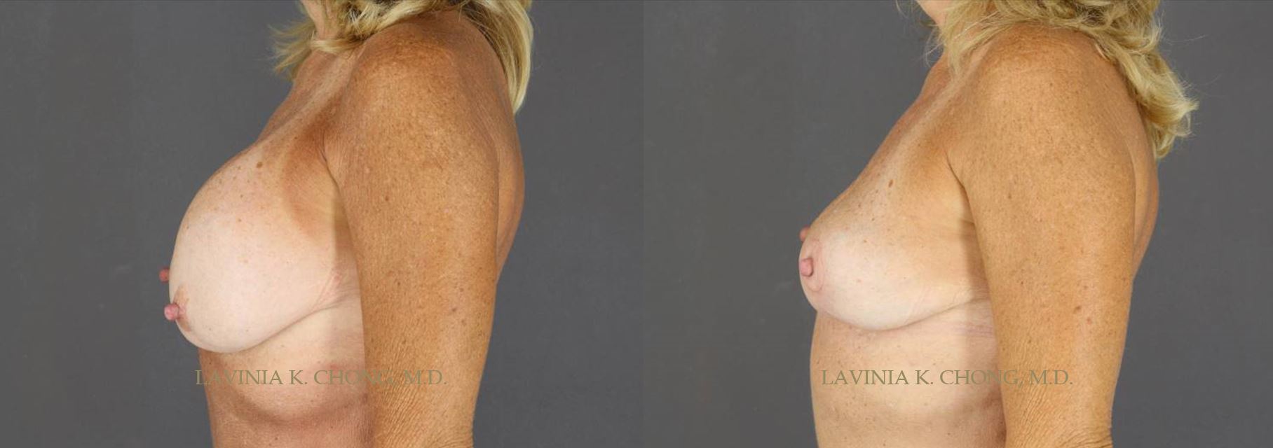 Before and After photo of 63 yr old desiring smaller lifted breast. Surgical plan includes Explantation of Allergan Silicone Breast Implants with Application of DuraSorb and Autogenous Fat Grafting to the Breast by female plastic surgeon in Newport Beach, California.