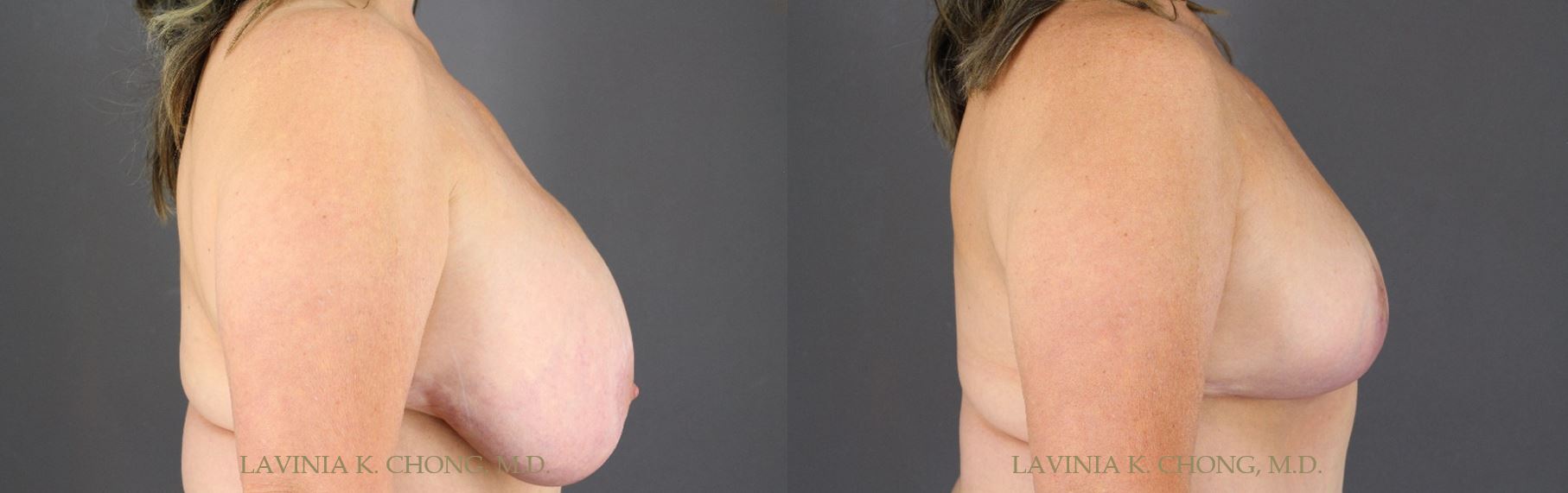Before and After photo of 56 yr old desiring smaller lifted breast. Patient history of McGhan Saline Breast Implants and Grade III Mammary Ptosis. Surgical plan includes Implant Explantation-Mastopexy with Application of DuraSorb and Liposuction of the Dorsal rolls by female plastic surgeon in Newport Beach, California.